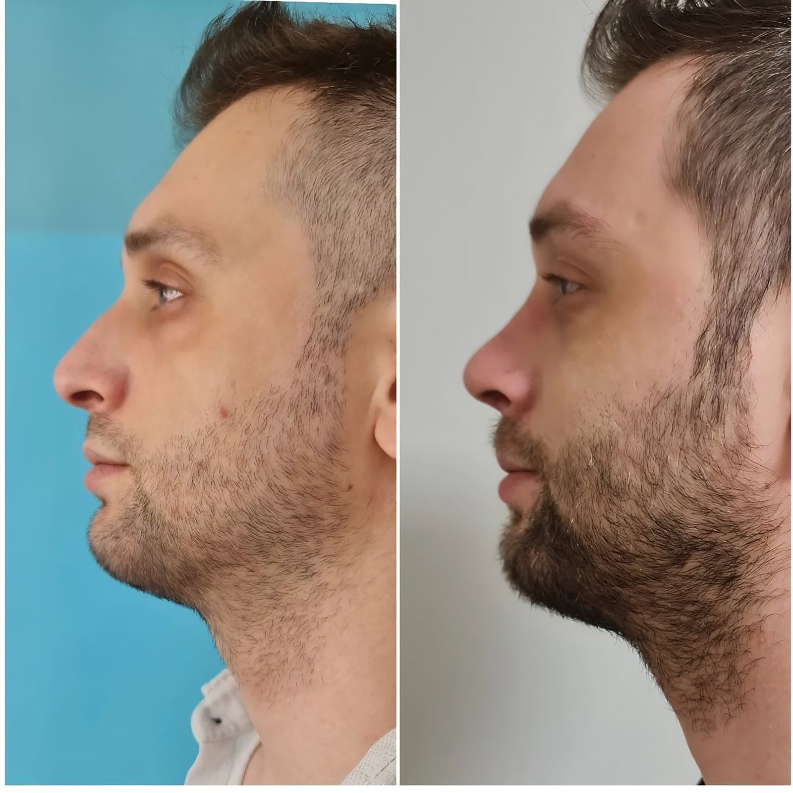 Op.Dr. Asuda Bıçakcı yanıtladı: Rinoplasti (Burun Estetiği) Nedir, Kimlere Yapılabilir, İyileşme Süreci ne kadar? 